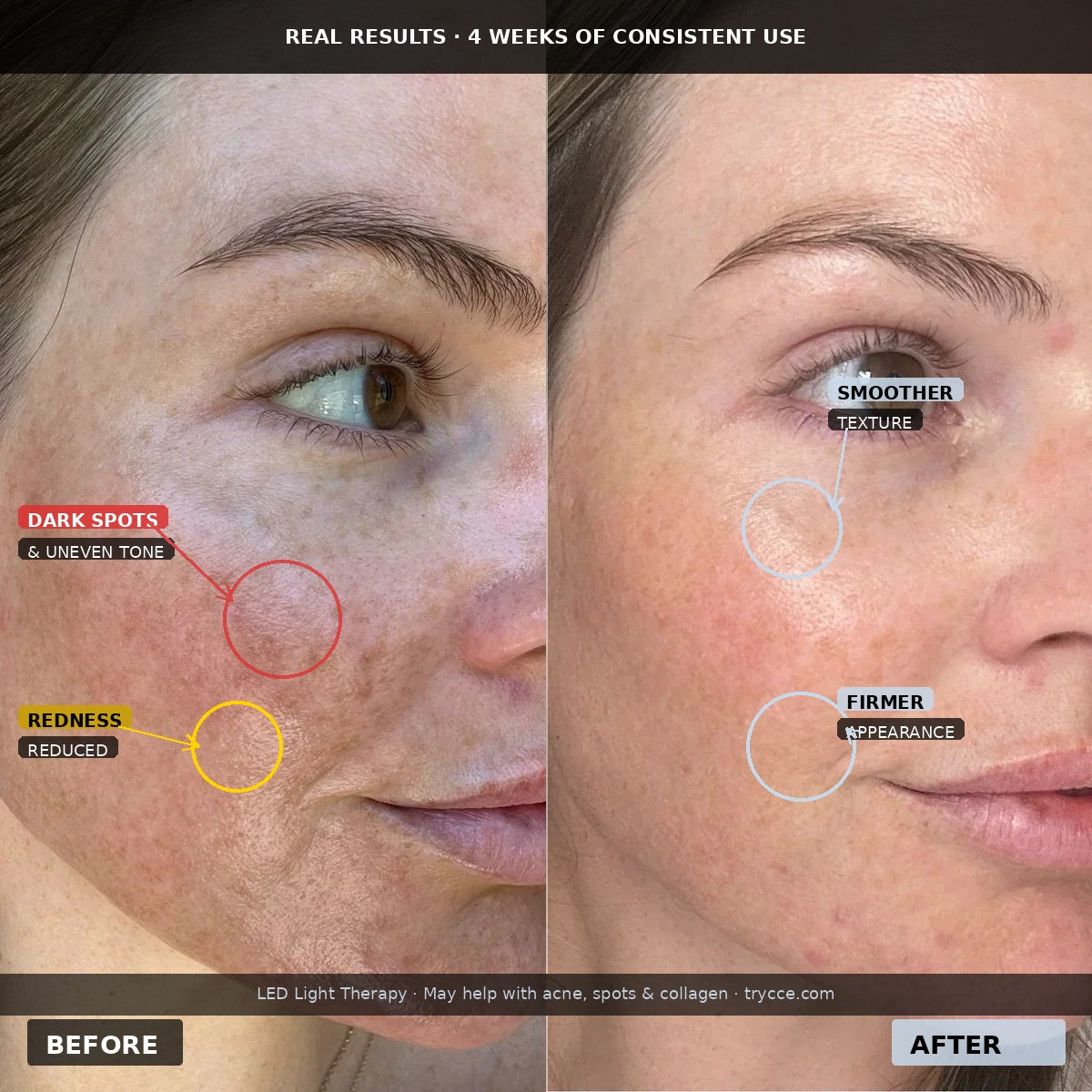 LED LIGHT THERAPY FACE MASK — ACNE, DARK SPOTS & COLLAGEN · 332 LEDs · CORDLESS